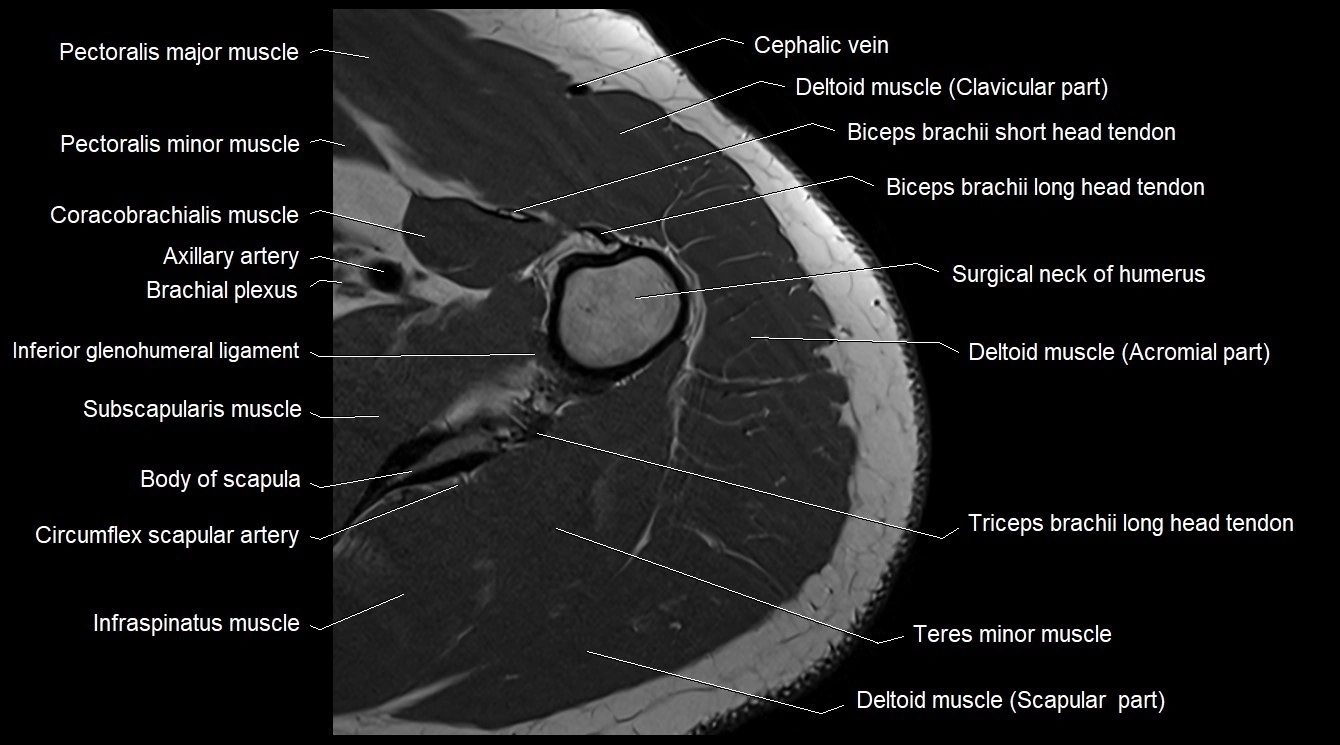 Upper arm( humerus) cross section anatomy MRI 3T axial image 15.webp